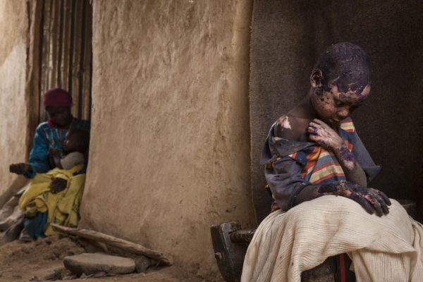 «Забытые горы Судана», Эдриен Оганесян (США) Семилетний Адам Абдель получил серьёзные ожоги после того, как рядом с его домом в Бургу (провинция Центральный Дарфур, Судан) разорвалась бомба