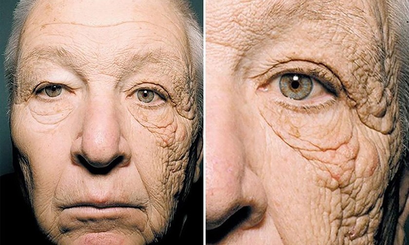 почему возникает рак кожи